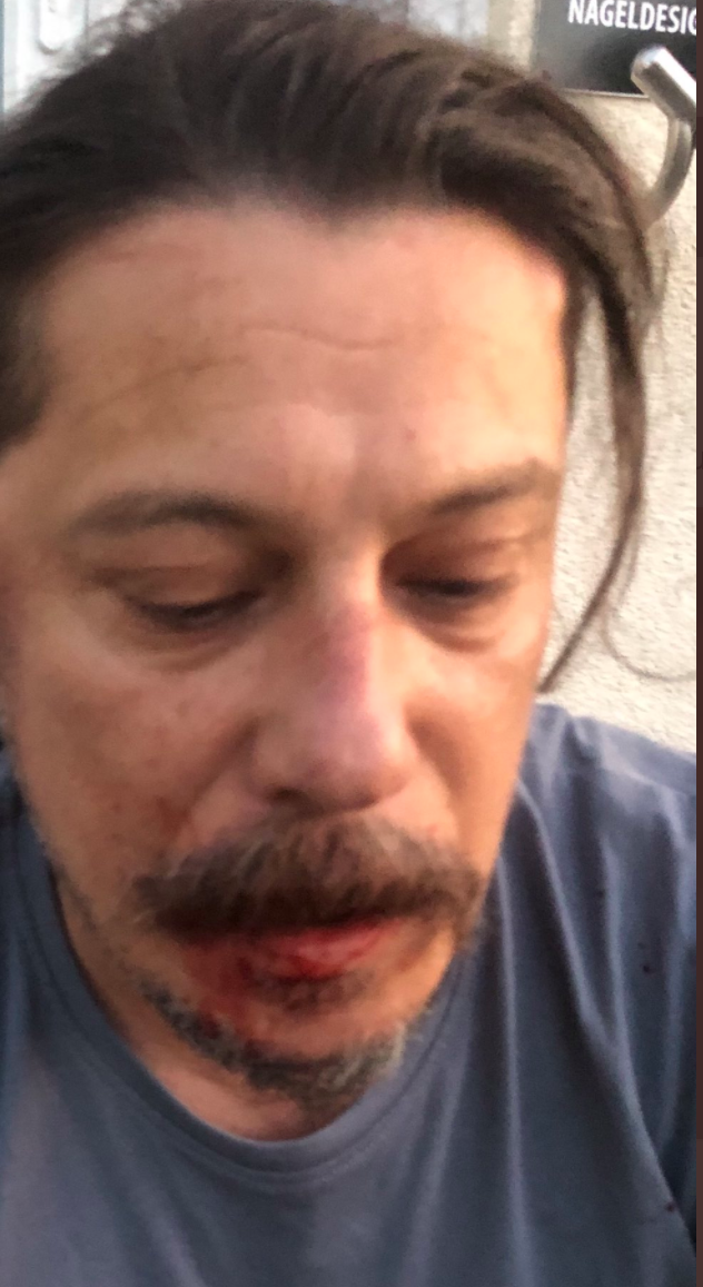 Erk Acarer postete nach dem Angriff Anfang Juli auf Twitter ein Foto seines verletzten Gesichts.