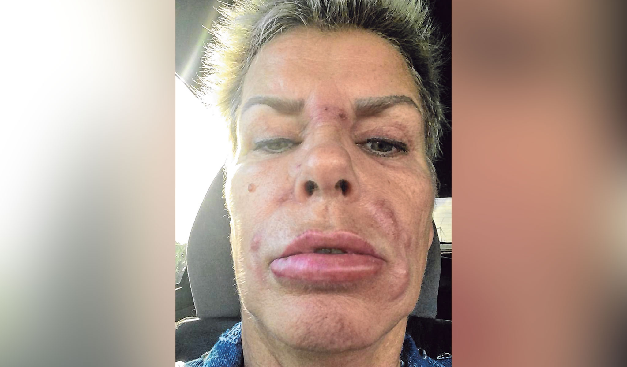 Ein Selfie einer Frau, ihr Gesicht ist angeschwollen