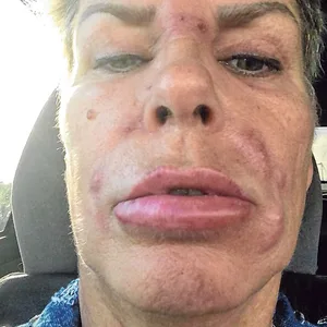 Ein Selfie einer Frau, ihr Gesicht ist angeschwollen