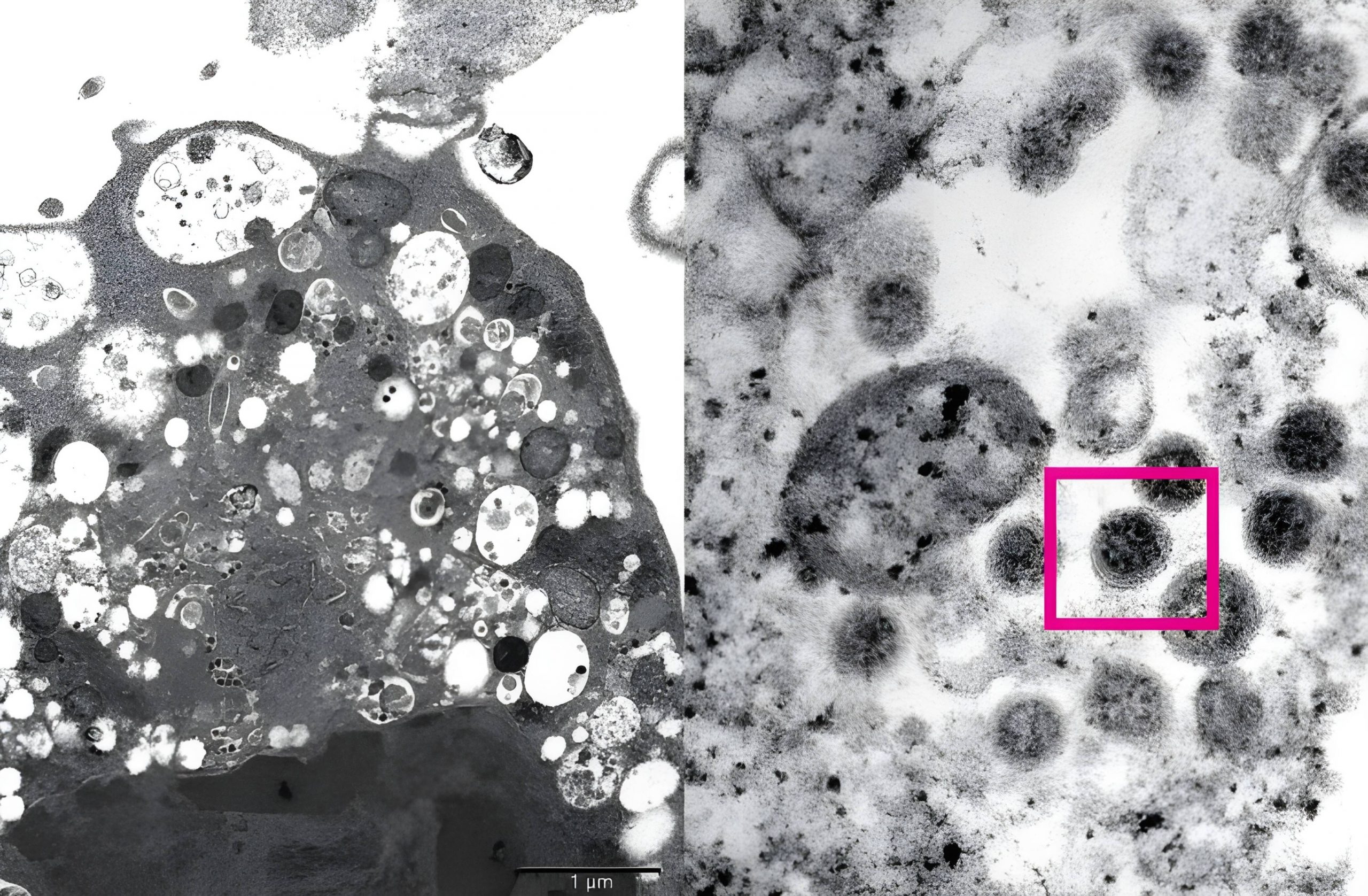 Die Aufnahme zeigt eine Zelle einer Affenleber, die mit Omikron infiziert ist. Die schwarzen Flecken sind die Viruspartikel.