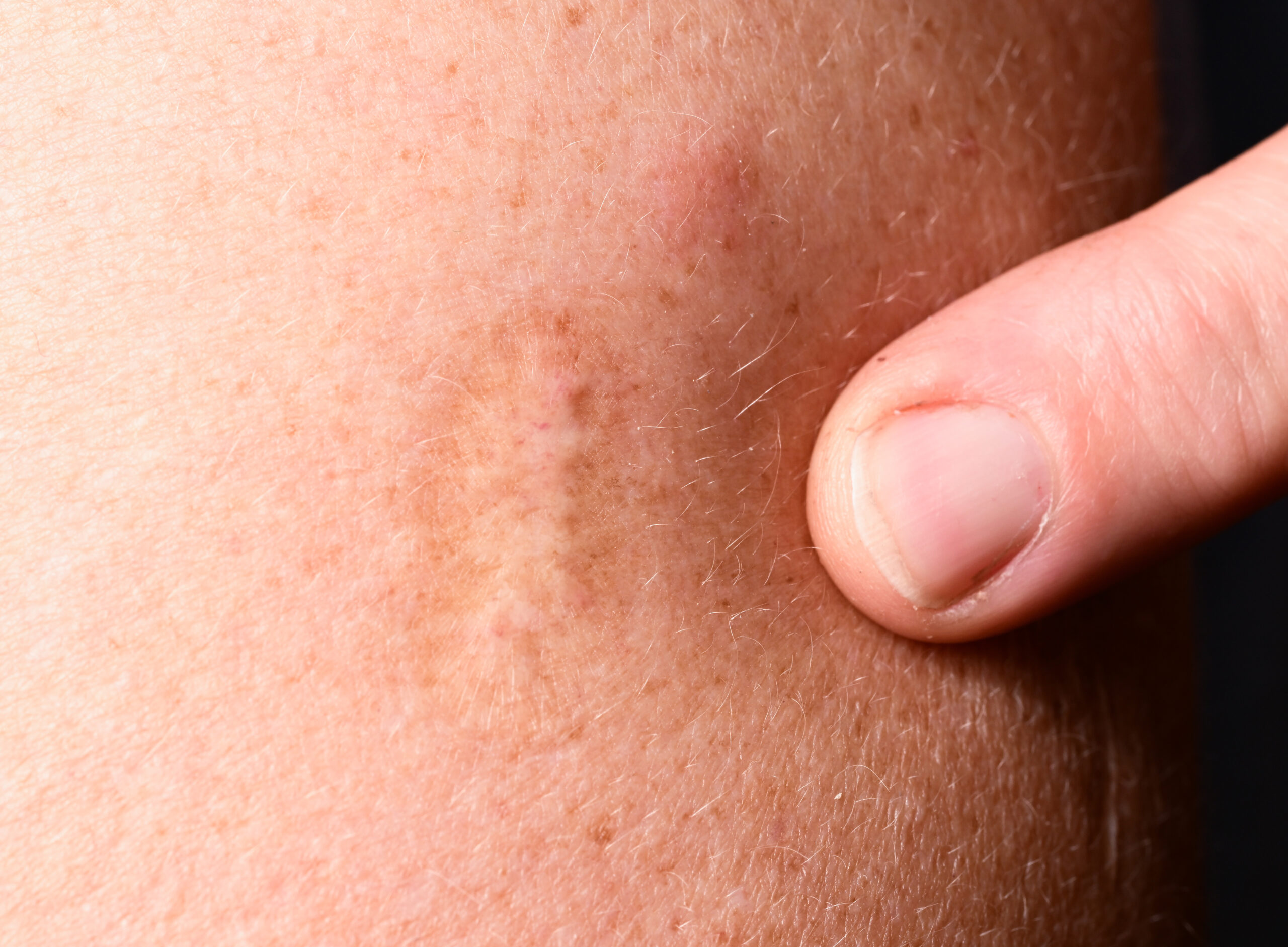ine Narbe einer Pockenimpfung ist an einem Oberarm sichtbar. Die Impfung wirkt wohl auch gegen Affenpocken.