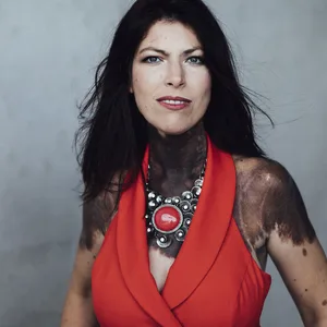 Ihre Lebenserwartung lag bei wenigen Jahren, prognostizierten die Ärzte. Heute ist Nannette Emmerich 46 – und steht im Rampenlicht.