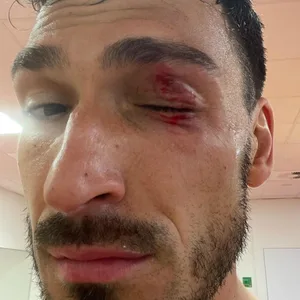 Mats Hummels mit geschwollenem Auge