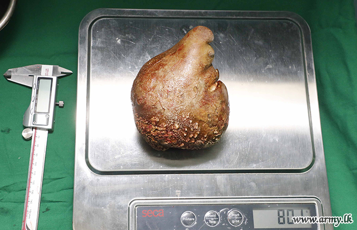 Fast 13,4 Zentimeter lang, 801 Gramm schwer: Ärzte in Sri Lanka haben einem Patienten den größten Nierenstein der Welt entfernt.