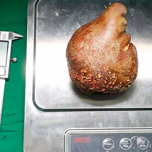 Fast 13,4 Zentimeter lang, 801 Gramm schwer: Ärzte in Sri Lanka haben einem Patienten den größten Nierenstein der Welt entfernt.