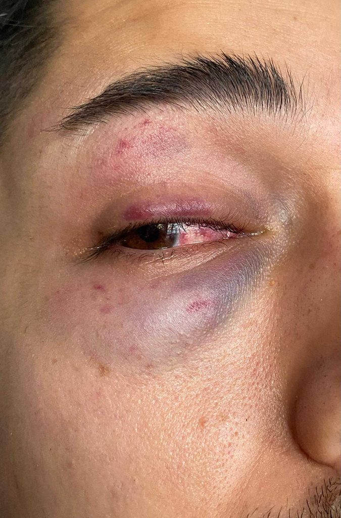 So sah Ricardos Auge nach der Attacke aus.