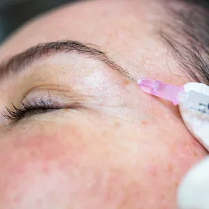 Einer Frau wird Botox gespritzt