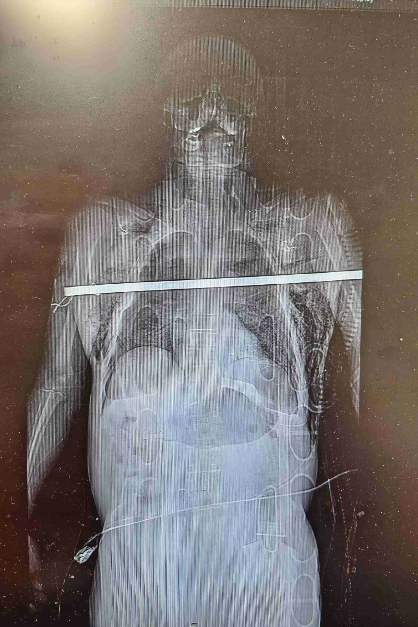 Auf einem Röntgenbild ist eine Eisenstange zu sehen, die durch den Oberkörper eines Mannes gebohrt ist.