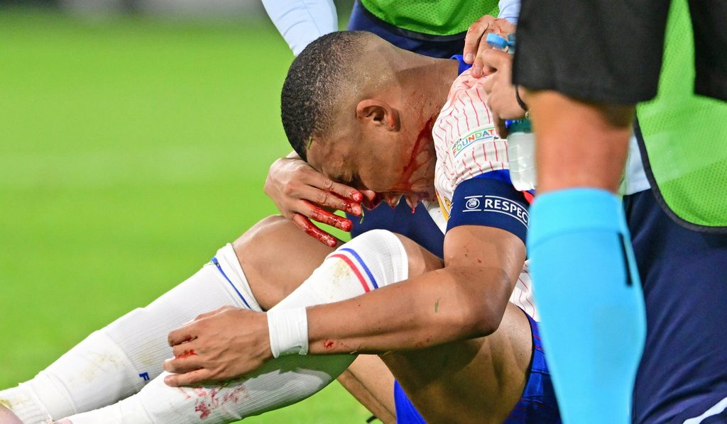 Kylian Mbappé mit blutender Nase