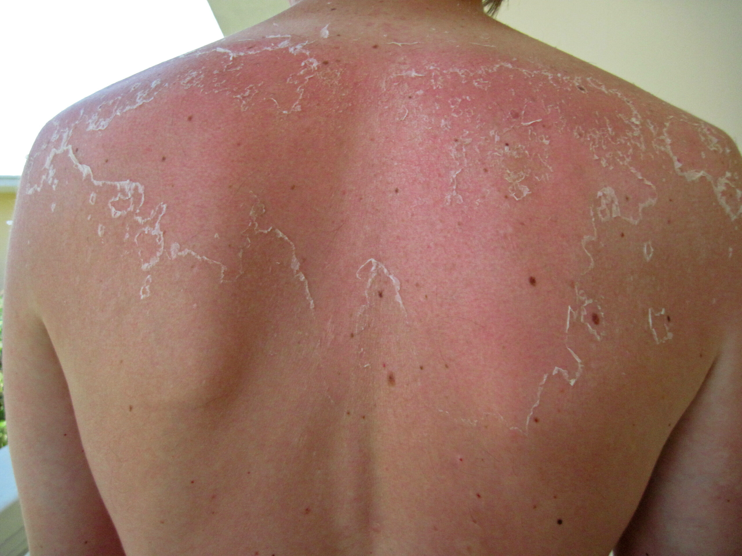 Schwerer Sonnenbrand am Rücken (Symbolbild).