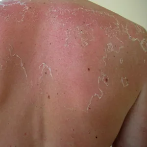 Schwerer Sonnenbrand am Rücken (Symbolbild).