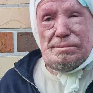 Mann Vater Hautkrankheit