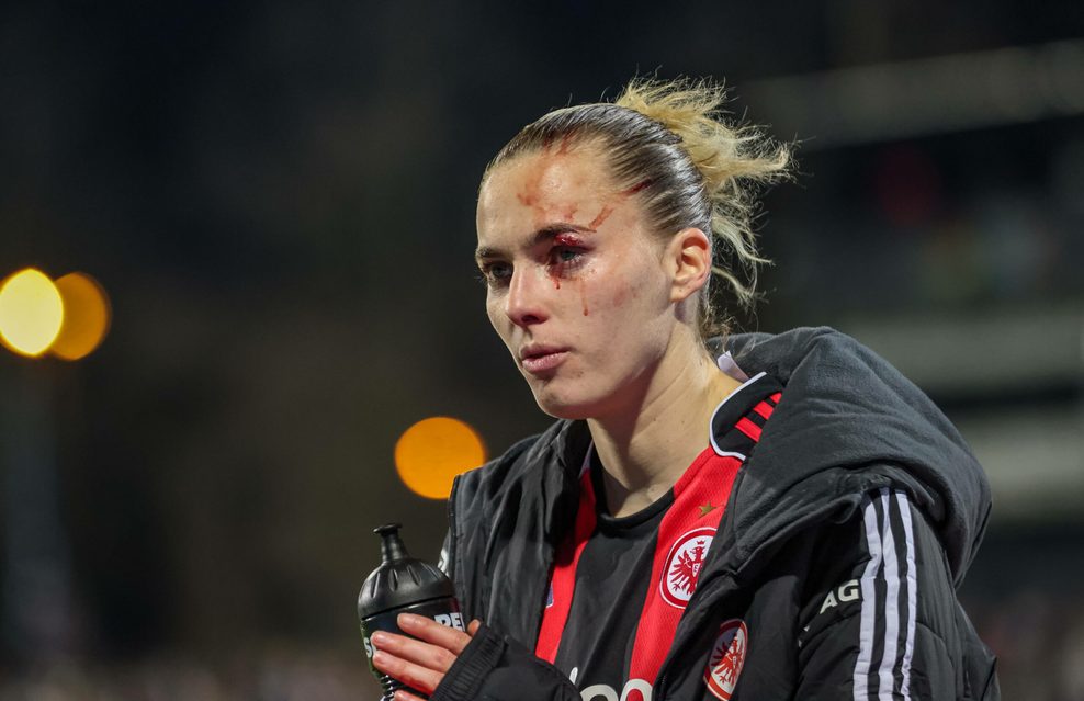 Laura Freigang verletzt sich im Spiel mit Frankfurt gegen Hoffenheim am Auge