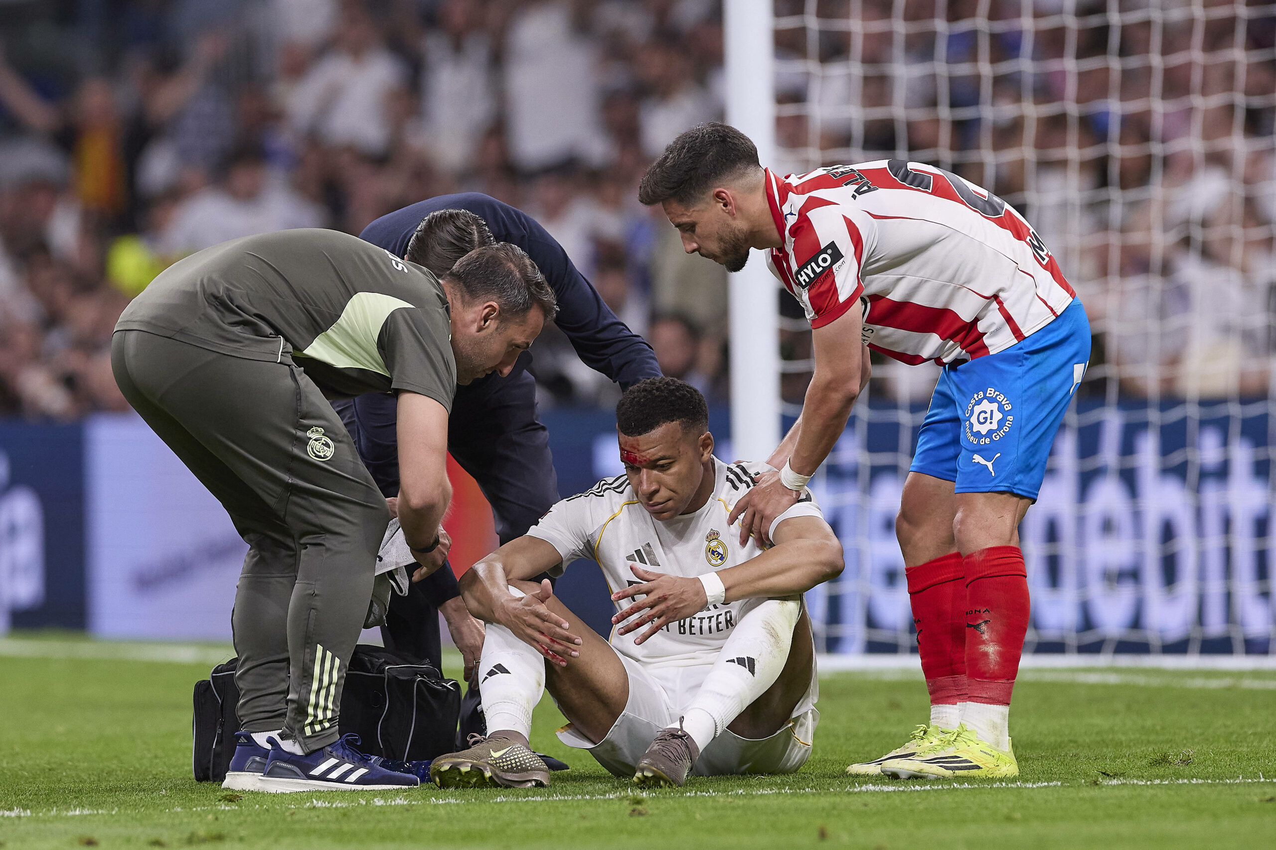 Kylian Mbappé mit einer Platzwunde an der Augenbraue.
